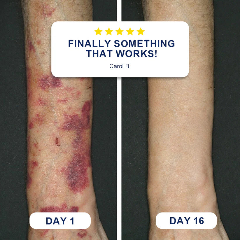 Evolvion®Bruise Repair & Skin-Strengthening Cream ✨